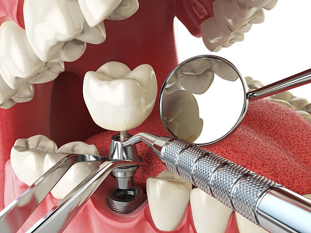 Best Emergency Dental Extractions in Pennside, PA